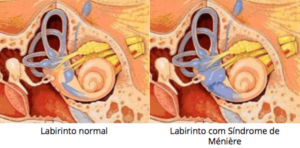 Doença de Ménière
