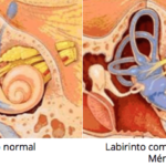 Doença de Ménière