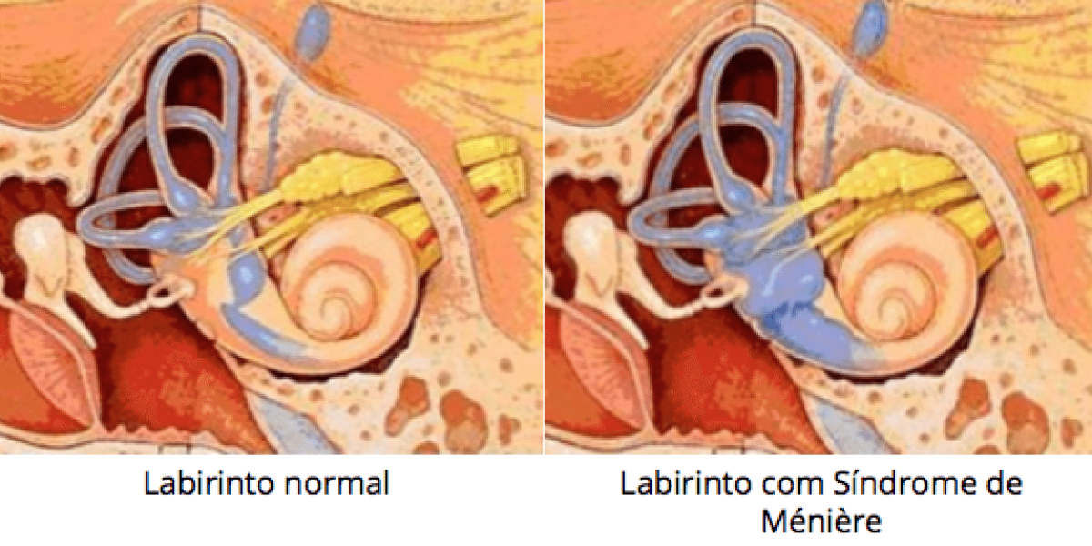 Doença de Ménière