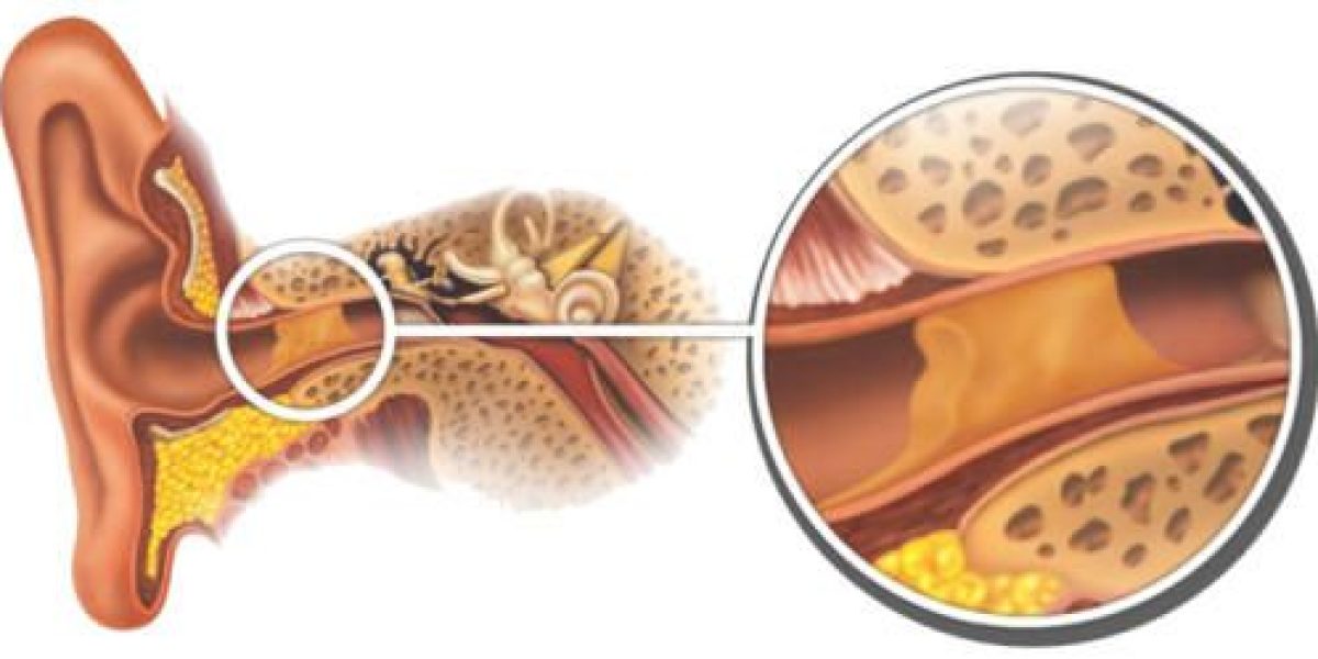 ouvido entupido ouvido entupido